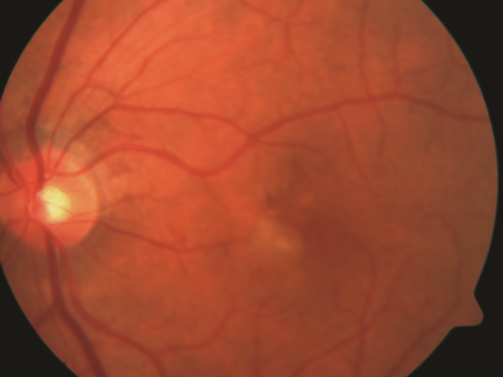 age related macular degeneration