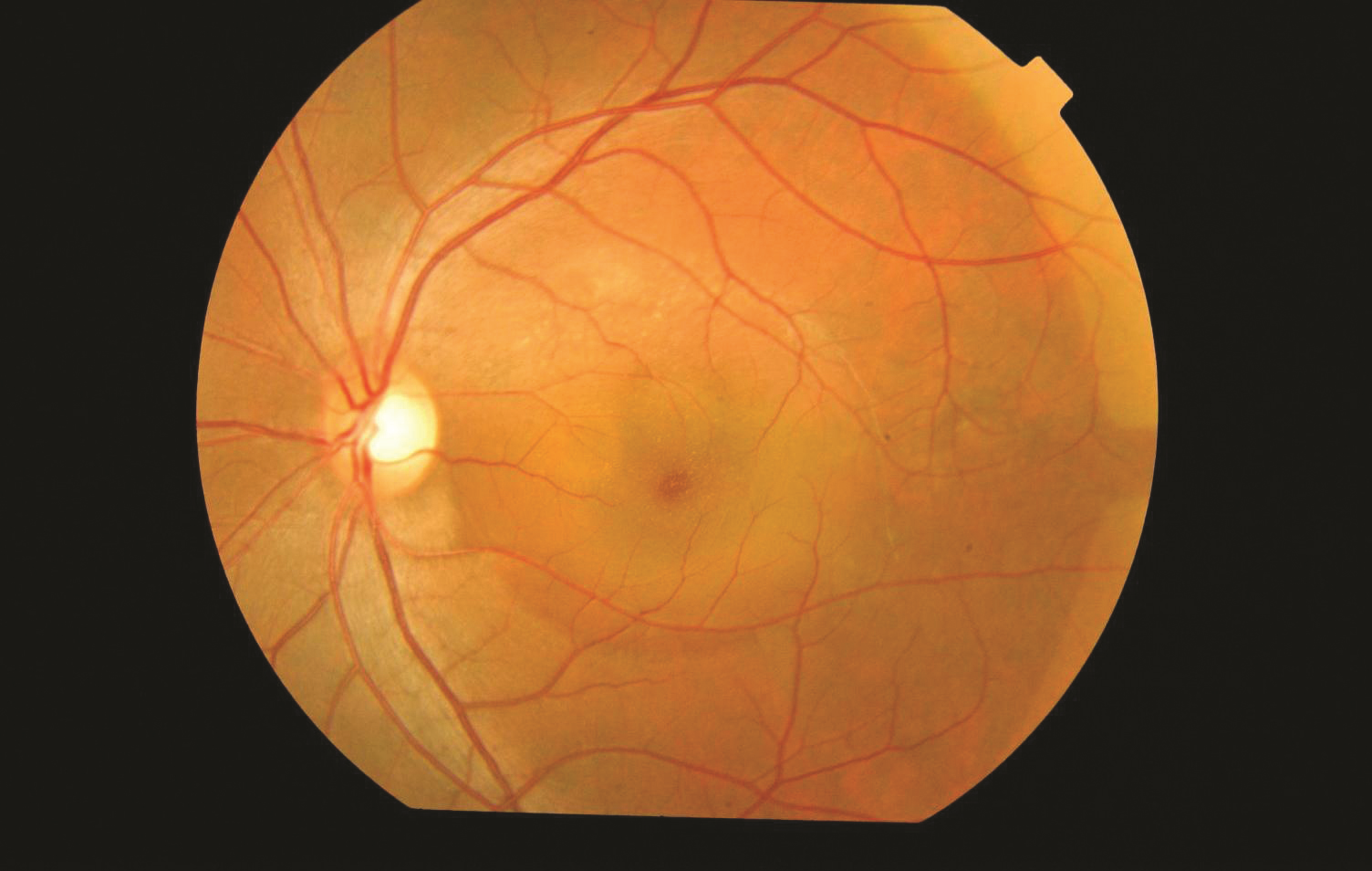 serous retinal detachment oct