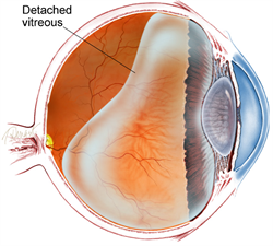  Diagram of the vitreous cavity during posterior vitreous detachment