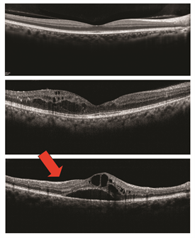 Macular Edema - Patients - The American Society of Retina Specialists