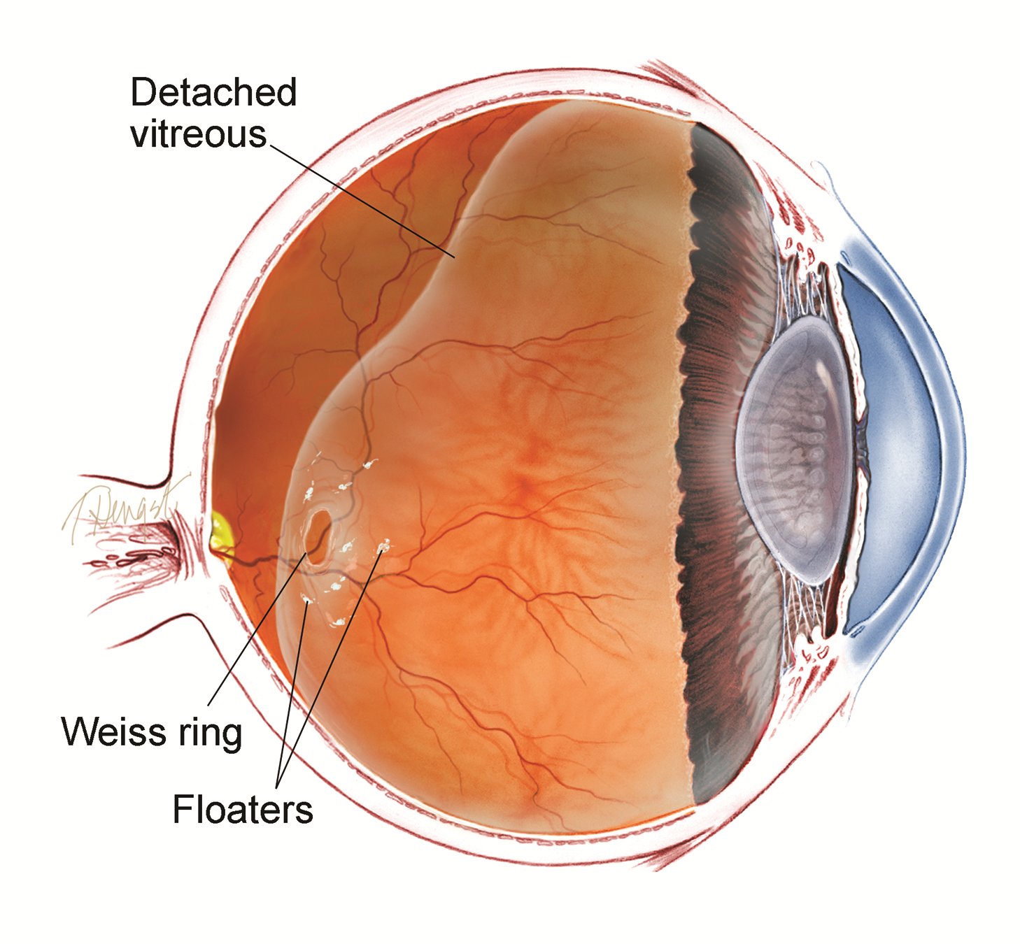 retinal detachment floaters