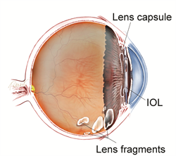 Fragmental Eye Retained Lens Fragments - Patients - The American Society of Retina ...