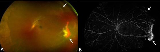 sickle cell retinopathy sea fan