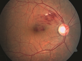 Branch Retinal Vein Occlusion - Patients - The American Society of ...