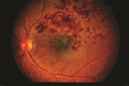 Macular Rvo Branch Retinal Vein Occlusion - Patients - The American Society of ...