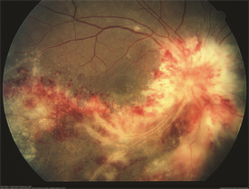 Infectious Retinitis - Patients - The American Society of Retina ...