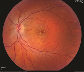 Infectious Retinitis - Patients - The American Society of Retina ...