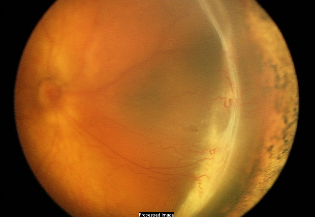 abnormal retina