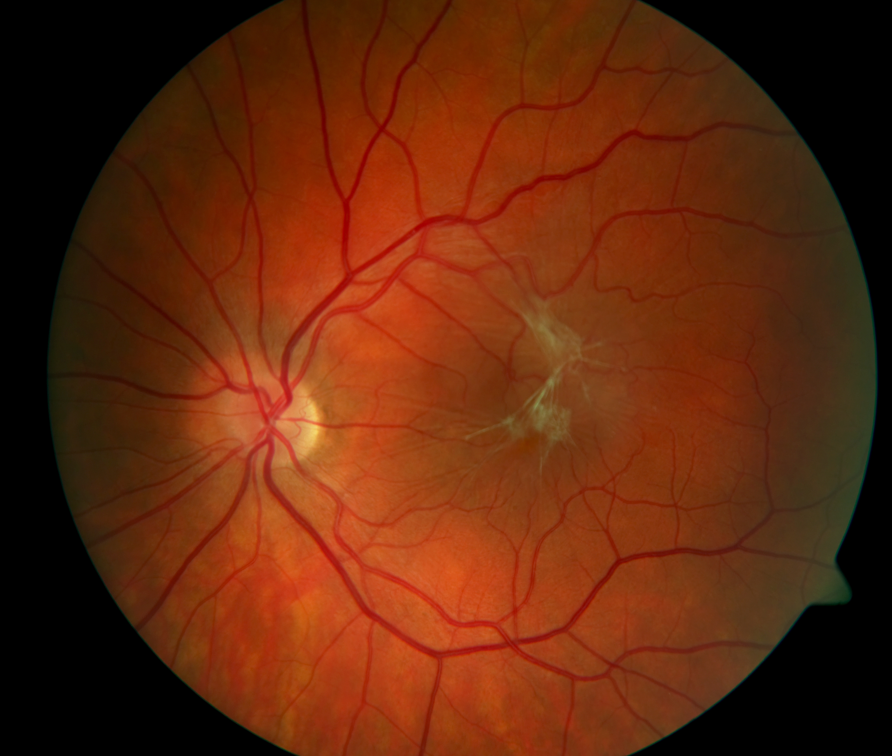 Retina Issues: What are the Symptoms?