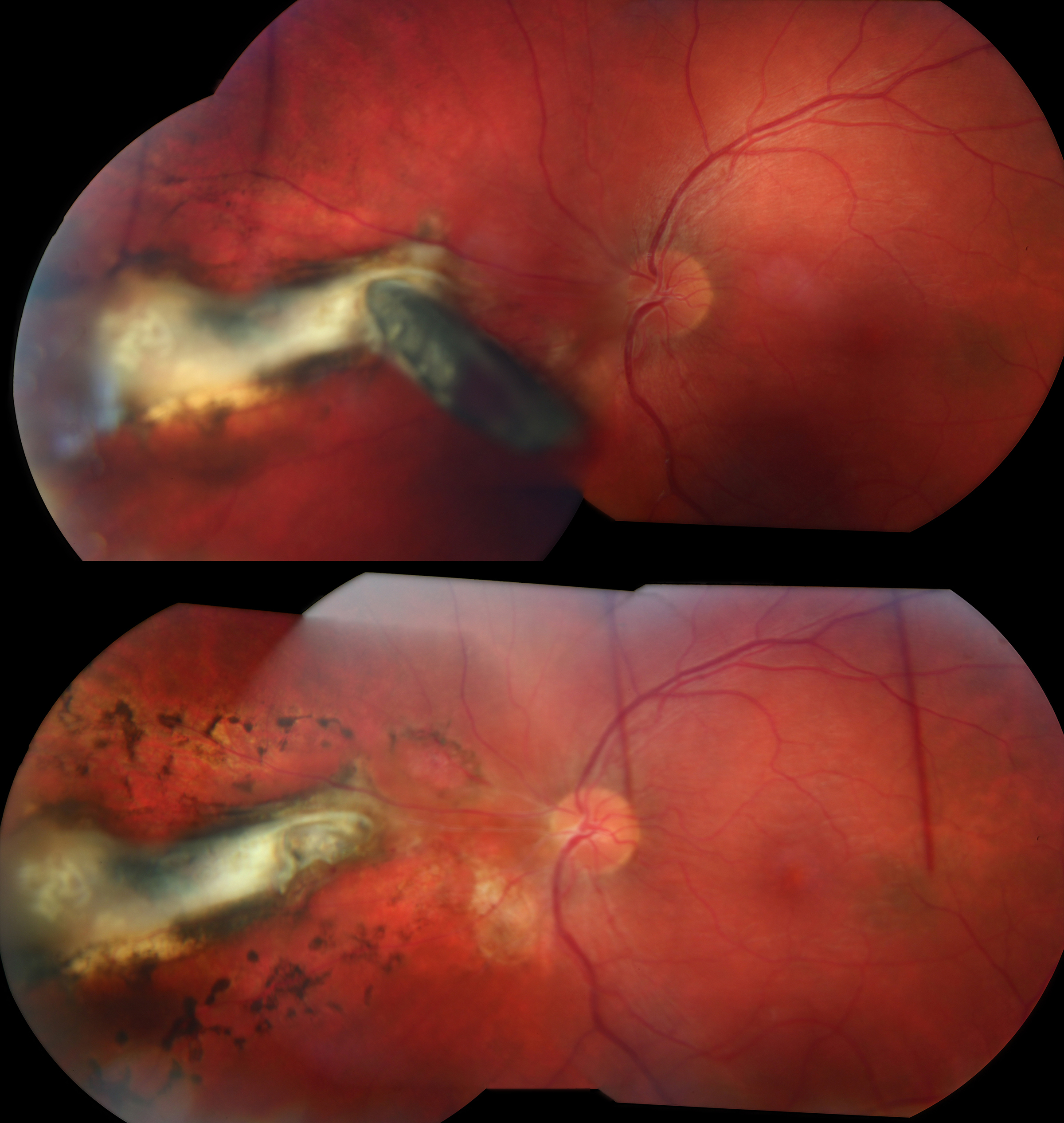 detached retina after cataract surgery